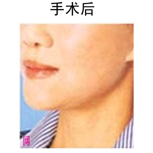 深蓝射频除皱要多少钱