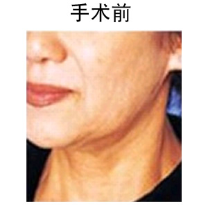 电波拉皮除皱