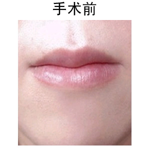 薄唇变厚整形