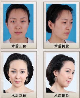苏晓蕾注射隆鼻前后对比照片