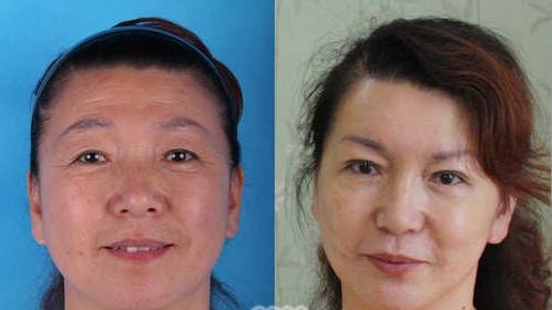 李东风上睑松弛前后对比照片