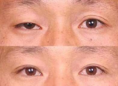 上睑下垂矫正前后对比照片