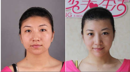 杨文华复合彩光祛痘前后对比照片