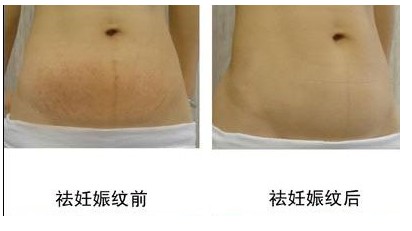 孕妇怎样防止妊娠纹