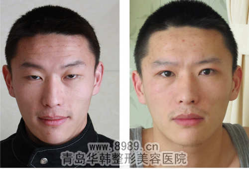 阳光韩式五爪拉皮去额头皱纹前后对比照片