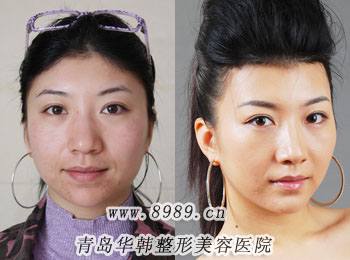 杨文华冰点激光脱发际线毛发前后对比照片