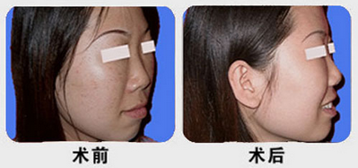 复合彩光去除黑斑前后对比