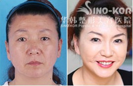 李东风除皱前后对比图