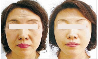 除皱美肤效果前后对比图