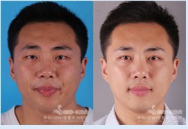 双眼皮整形效果前后对比图