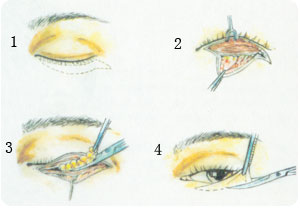 美无痕·爱无限_去眼袋_青岛华韩整形美容医