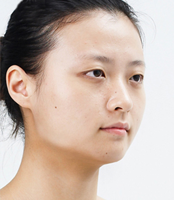 什么是V-line四方脸整形术?