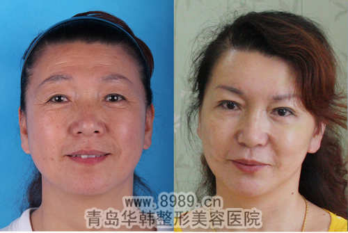 非手术面部除皱 真正的魅力童颜术_青岛华韩整