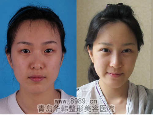 彩光和e光祛斑效果哪个好_青岛华韩整形美容