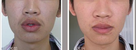 <em>厚唇变薄</em>是永久性吗_青岛华韩整形美容医院