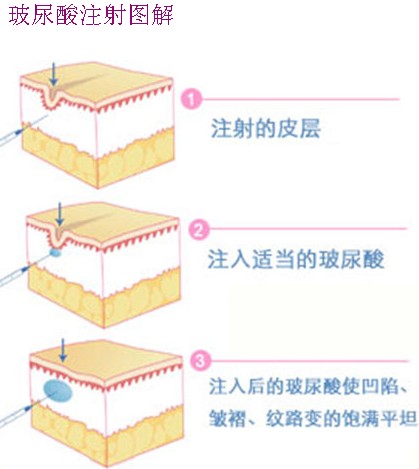 玻尿酸除皱针有无副作用_青岛华韩整形美容医