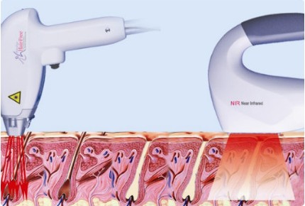岛哪种激光脱毛术最先进_青岛华韩整形美容医