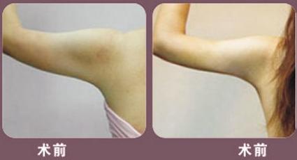胳膊吸脂减肥好不好_青岛华韩整形美容医院