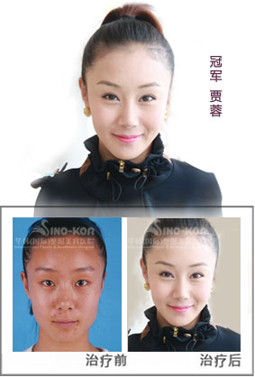 做面颊填充去哪家医院好_青岛华韩整形美容医院