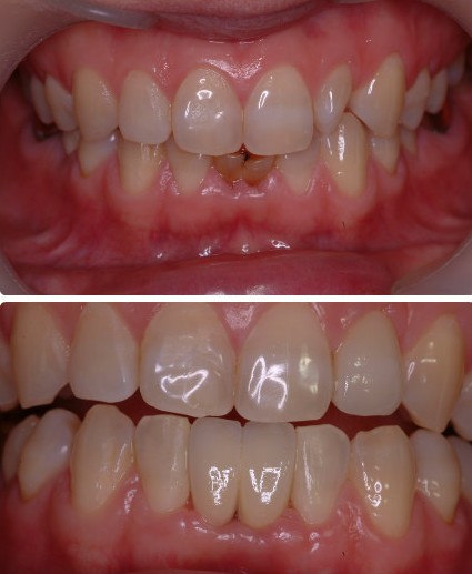 青岛种植牙哪儿做比较好_青岛华韩整形美容医