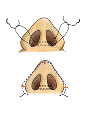 朝天鼻整形前后对比照_青岛华韩整形美容医院