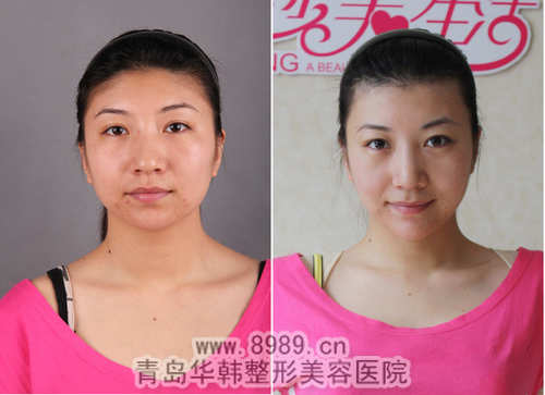 山东哪家医院做冰点脱毛好_青岛华韩整形美容