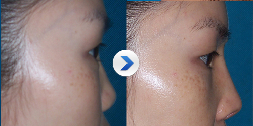 鼻翼整形术 鼻翼宽大者之福音_青岛华韩整形美