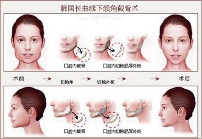 如何改变<em>下颌角</em>肥大_青岛华韩<em>整形</em>美容医院